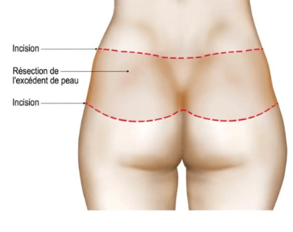 Intervention du bodylift 