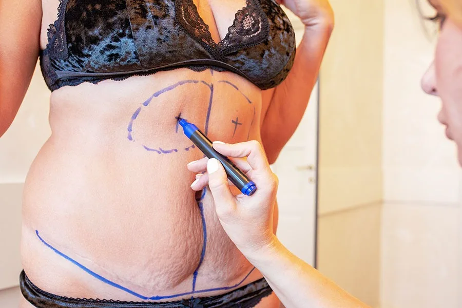Consultation d'un chirurgien plastique en vue d'une plastie abdominale