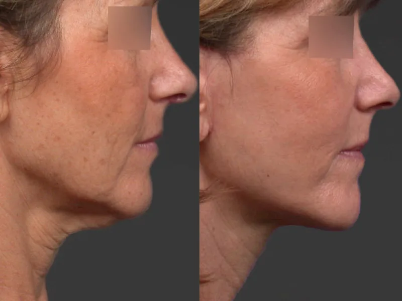 Réalisation d'un mini lifting du visage Résultat avant/après à 1 mois d'intervalle permettant une redéfinition du cou et de l'ovale du visage