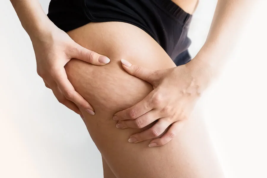 Les effets de la cellulite sur les jambes des femmes
