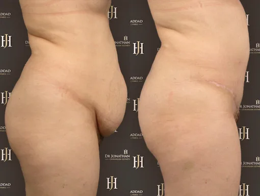 Avant-après un Mommy Makeover, plastie abdominale permettant de retrouver un ventre plat.