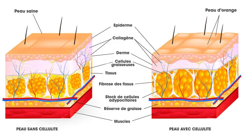 Schéma de la formation de la cellulite