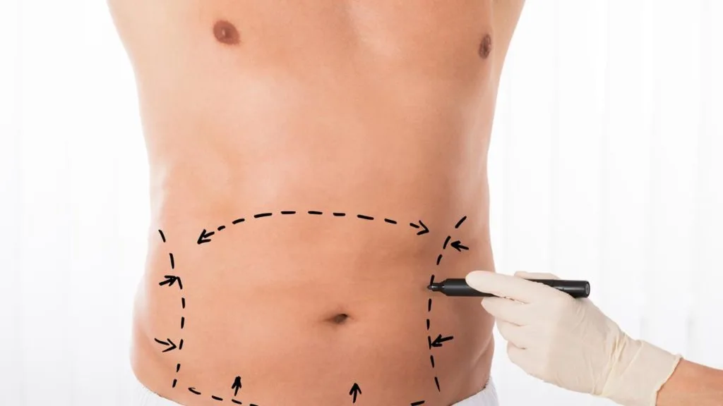 Marquage des zones avant une liposuccion