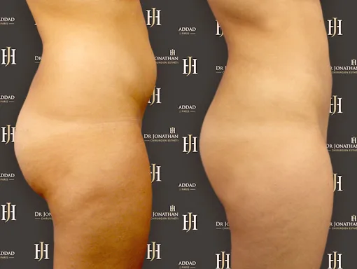 liposuccion douce du ventre sans chirurgie
