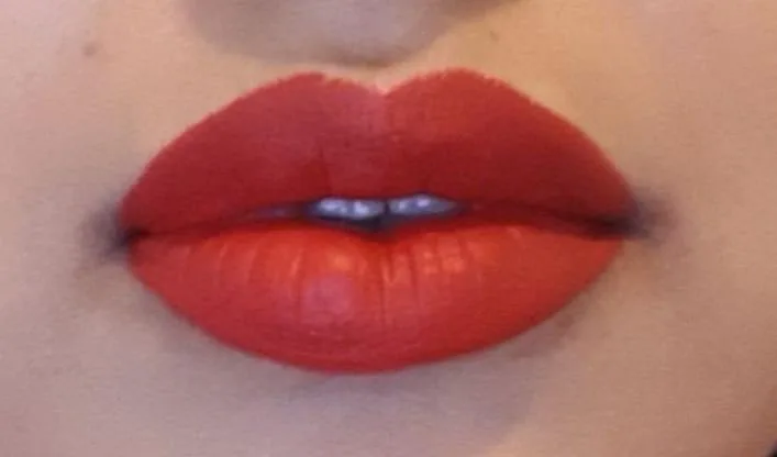 Résultat après injection des lèvres selon la méthode Russian Lips