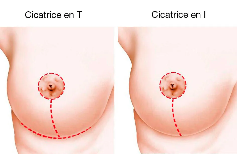 Cicatrices après réduction mammaire