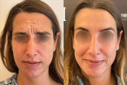 Résultat du Baby Botox sur rides du front