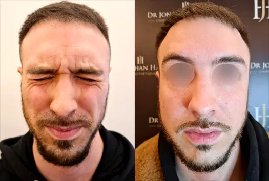 Avant-Après injections Baby Botox