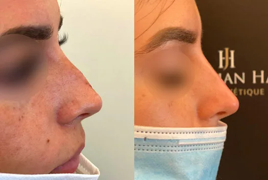 Résultat après injections de hyaluronidase au niveau du nez