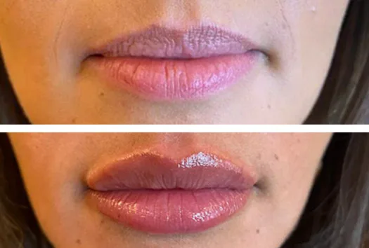 Traitement des lèvres par injection, avec effet russian Lips
