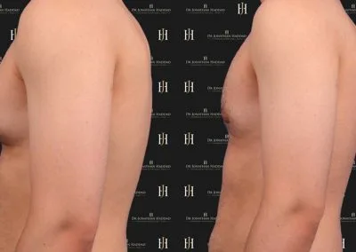resultat après une gynecomastie