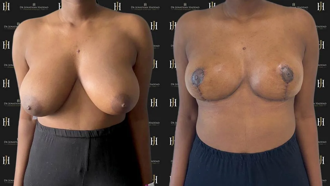 Réduction mammaire, photos des cicatrices