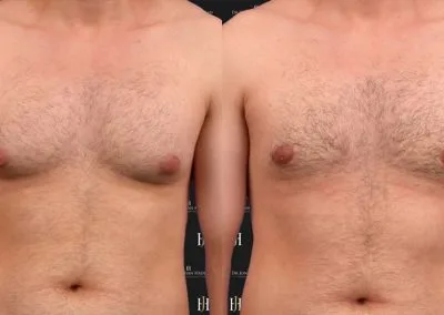 rédcution du sein chez l'homme
