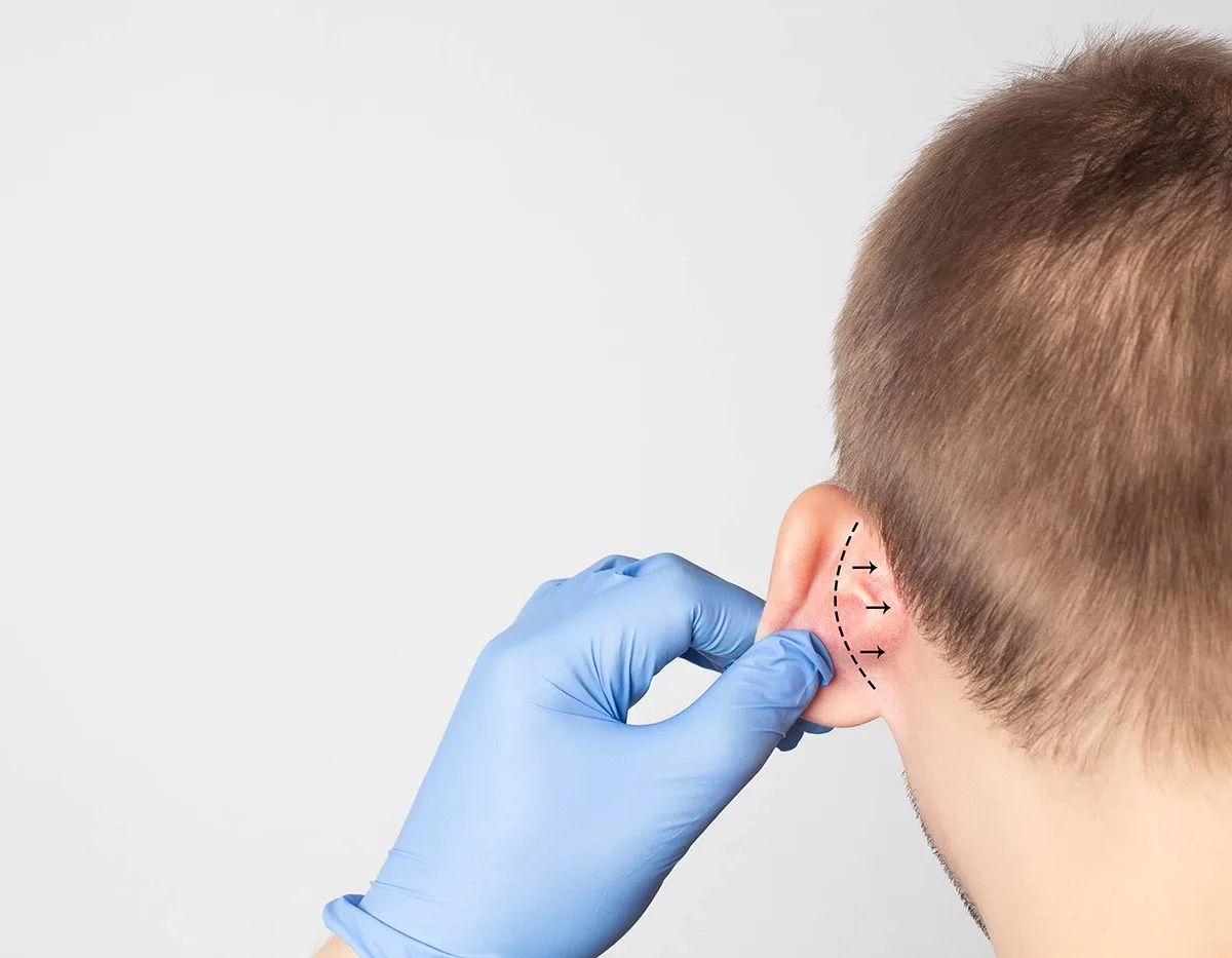 L'otoplastie , chirurgie des oreilles décollées remboursée par la sécurité sociale