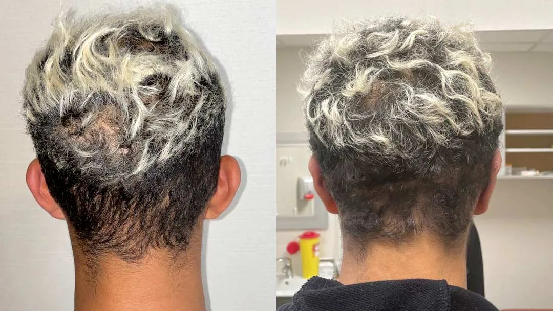 Otoplastie prise en charge par la sécurité sociale