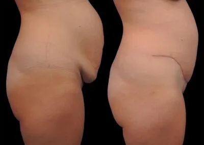 Avant-après : cure de diastasis par abdominoplastie