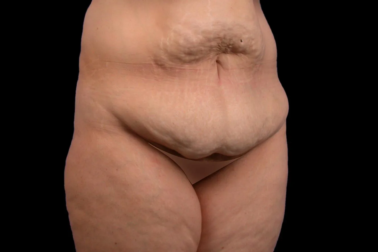 tablier abdominal recouvrant le pubis