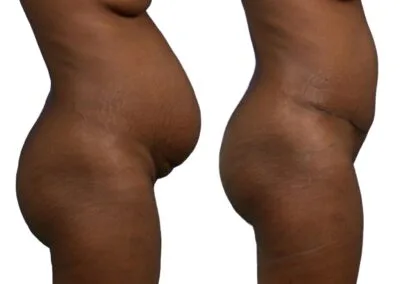Diastasis des grands droits avec tablier abdominal permettant une prise en charge