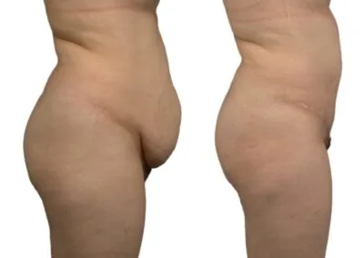 Avant-apres-traitement-diastasis-grands-droits-abdomen