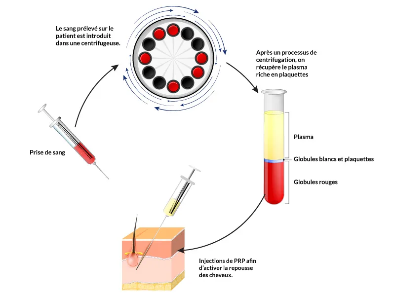 Processus d'extraction du PRP pour les cheveux