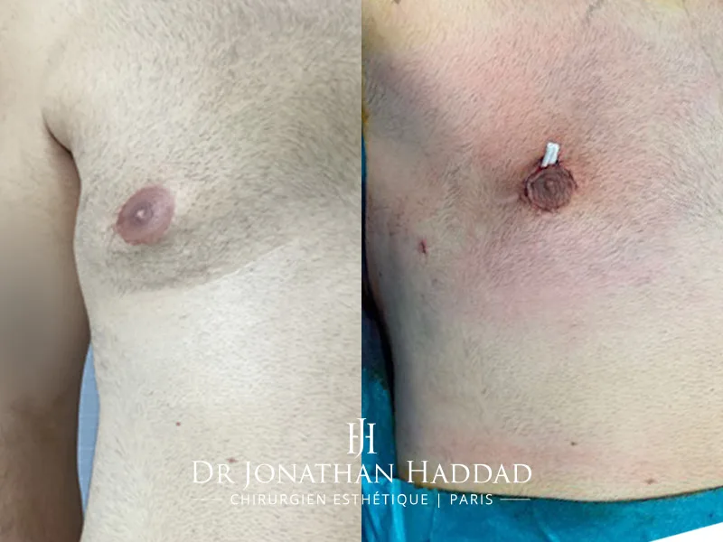Photo avant après une chirurgie d'adipomastie traitée par lipoaspiration
