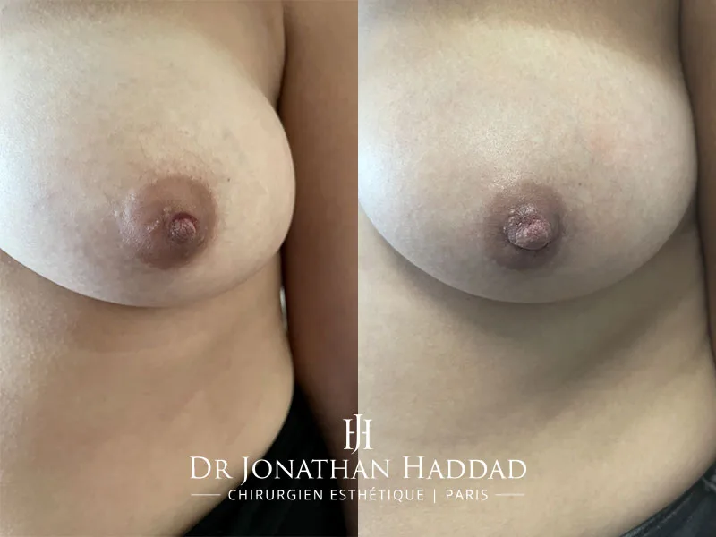 photo-apres-chirurgie-mamelons-invagines Avant-Après chirurgie des mamelons invaginés