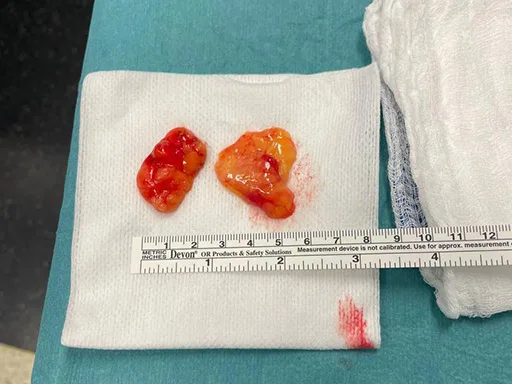 Retrait des boules de bichat pour affiner le visage