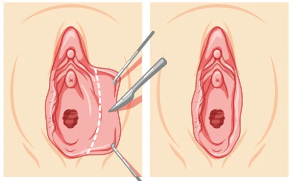 Avant après chirurgie de réduction des petites lèvres, nymphoplastie