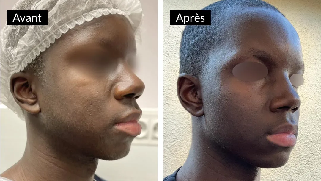 Avant après bichectomie, réduction de la boule de bichat