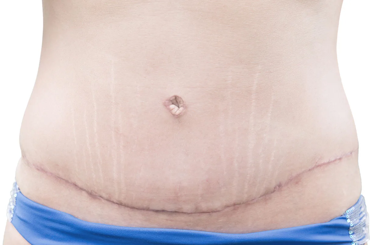 cicatrices après abdominoplastie correction du tablier abdominal