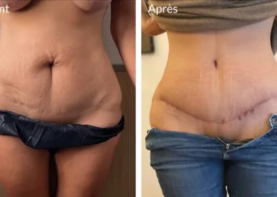 Cicatrice 6 mois après abdominoplastie