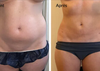 Avant après lipoaspiration du ventre et des hanches par le Dr HADDAD, chirurgien esthétique à Paris