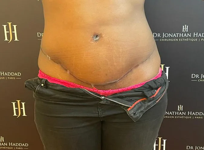 Reprise de cicatrice chéloïde inflammatoire après une abdominoplastie