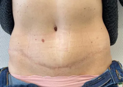 Cicatrice après abdominoplastie à 1 an postopératoire