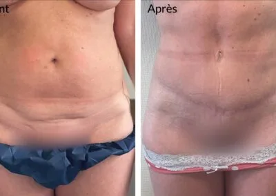 Cicatrice après 2 ans postopératoires