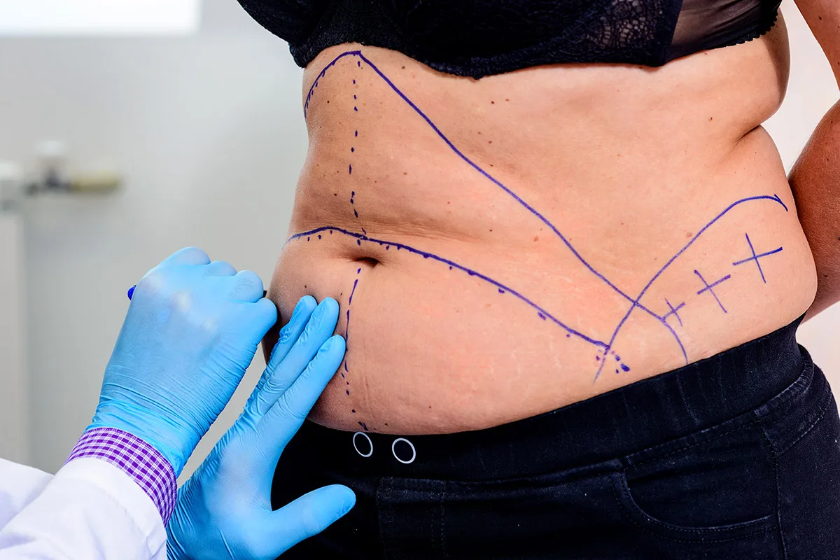 dessin-preoperatoire-abdominoplastie Dessin avant opération de plastie abdominale