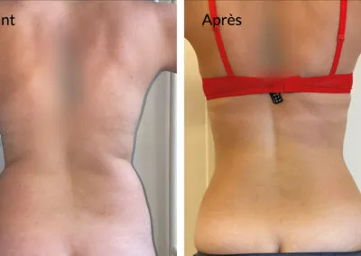 Résultat d'une liposuccion à 6 mois postopératoires