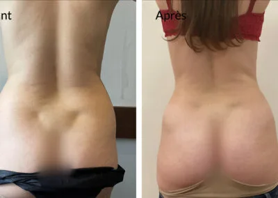 Lipoaspiration du ventre, des hanches et poignées d'amour