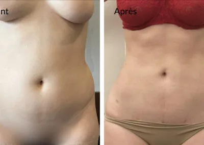 liposuccion du ventre après 6 mois postopératoires