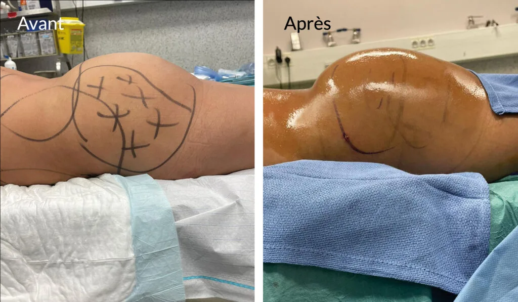 Bbl-brazilian-butt-lift-paris-dr-haddad
