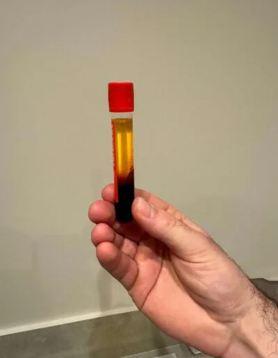 Séparation du plasma riche en plaquettes