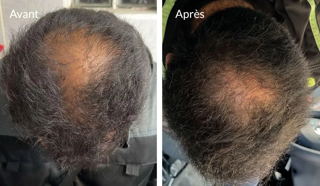 Résultat de repousse après injections de prp cheveux