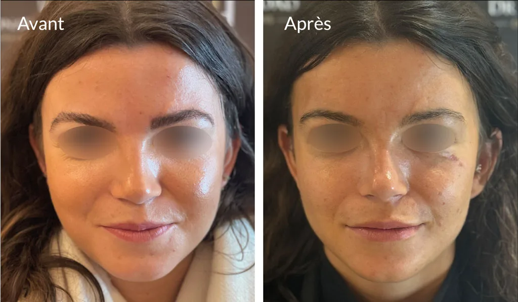 Avant/après bichectomie par le Dr Haddad à Paris