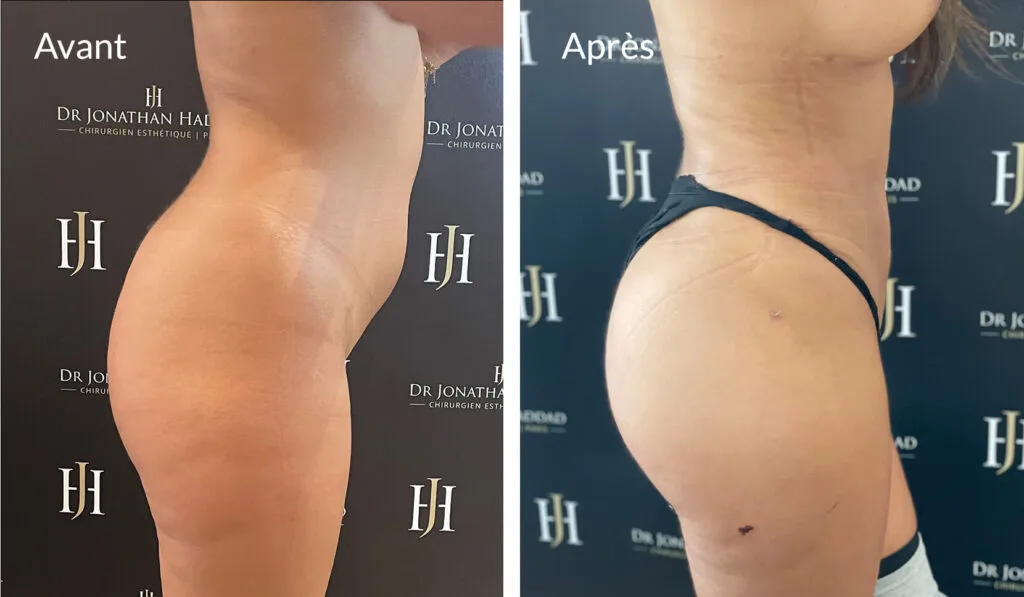 avant/après augmentation des fesses bbl