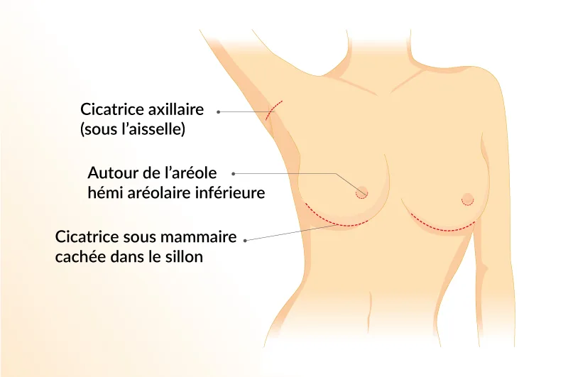 Les cicatrices après augmentation mammaire par prothèses