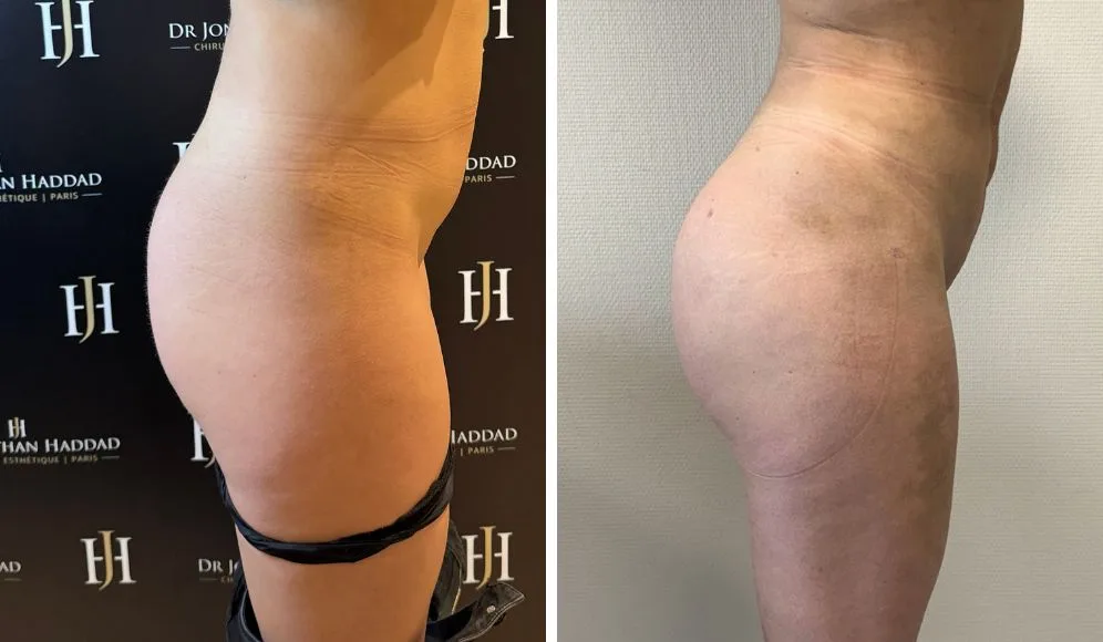 Résultat d'une augmentation de la taille des fesses par lipofilling à Paris par le Docteur Jonathan Haddad