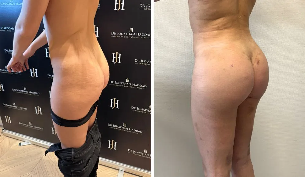 Résultat d'un lipofilling des fesses, Brazilian Butt Lift