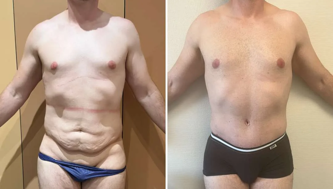 Résultat après abdominoplastie