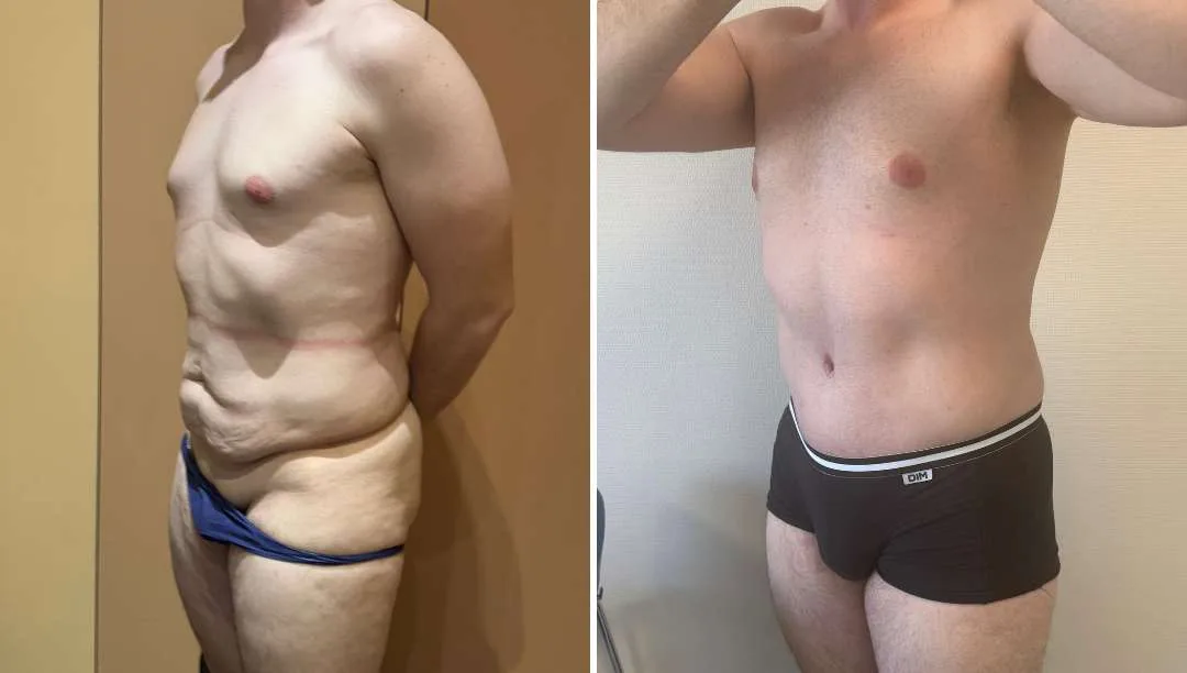 Élimination de la graisse du ventre par abdominoplastie