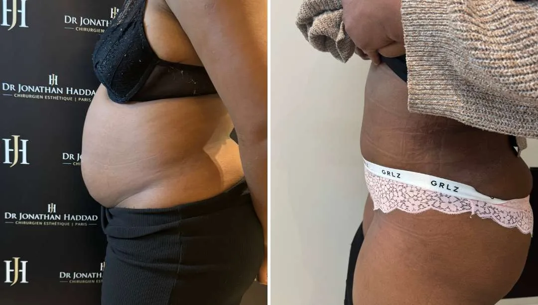 Avant-après plastie abdominale par le Docteur HADDAD